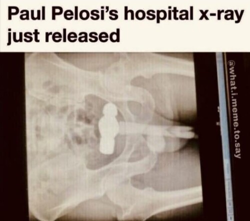 paul-pelosis-hospital-x-ray-just-released-v0-jbqwxdwtjuw915f77dabf46eb6ca7.jpeg