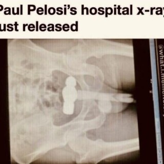 paul-pelosis-hospital-x-ray-just-released-v0-jbqwxdwtjuw915f77dabf46eb6ca7